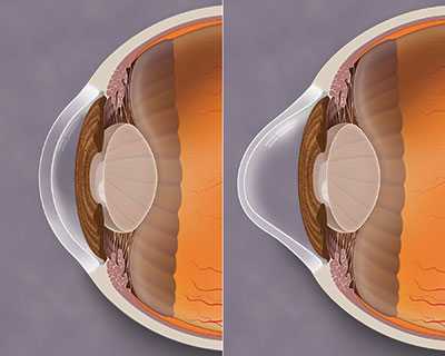 Keratoconus Specialists in Phoenix AZ