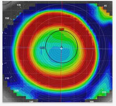 Corneal Refractive Therapy in Phoenix AZ