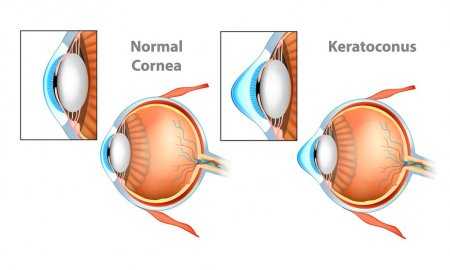 Keratoconus Specialists Near Me