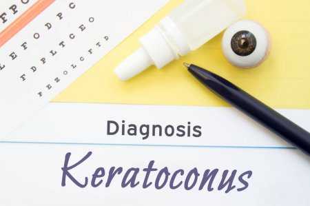 keratoconus causes